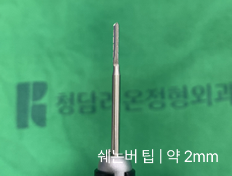 무지외반증 최소침습수술에 사용하는 약 2mm 수술 기구
